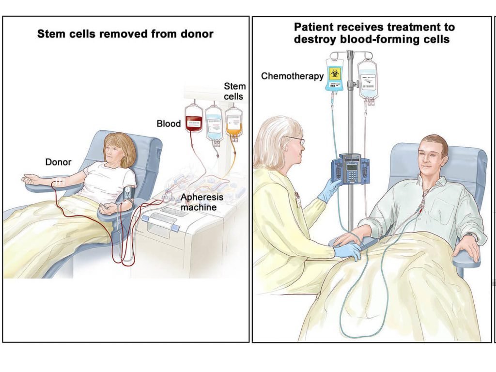 Stem Cell treatment for Cancer