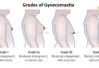 The Different Grades and Causes of Gynecomastia