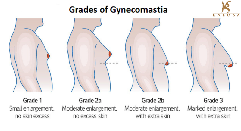 The Different Grades and Causes of Gynecomastia