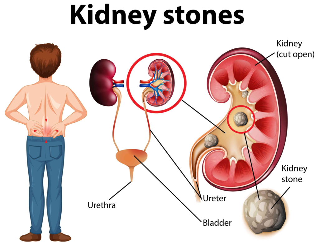 How to Deal with Kidney Stone?