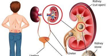 How to Deal with Kidney Stone?