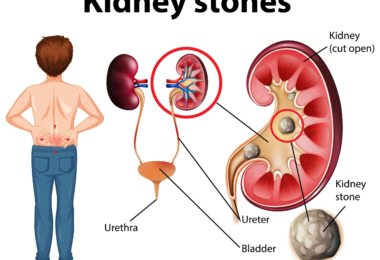 How to Deal with Kidney Stone?