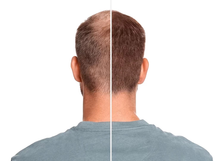 Hair Transplant Recovery Tips: Dos and Don'ts for Faster Healing