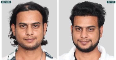 Planning Hair Transplantation? Read This Before You Take the Leap