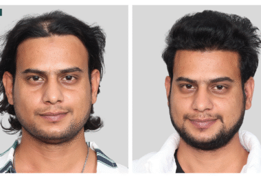 Planning Hair Transplantation? Read This Before You Take the Leap