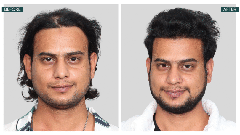 Planning Hair Transplantation? Read This Before You Take the Leap